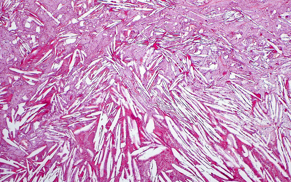 Cholesterol crystals, light micrograph