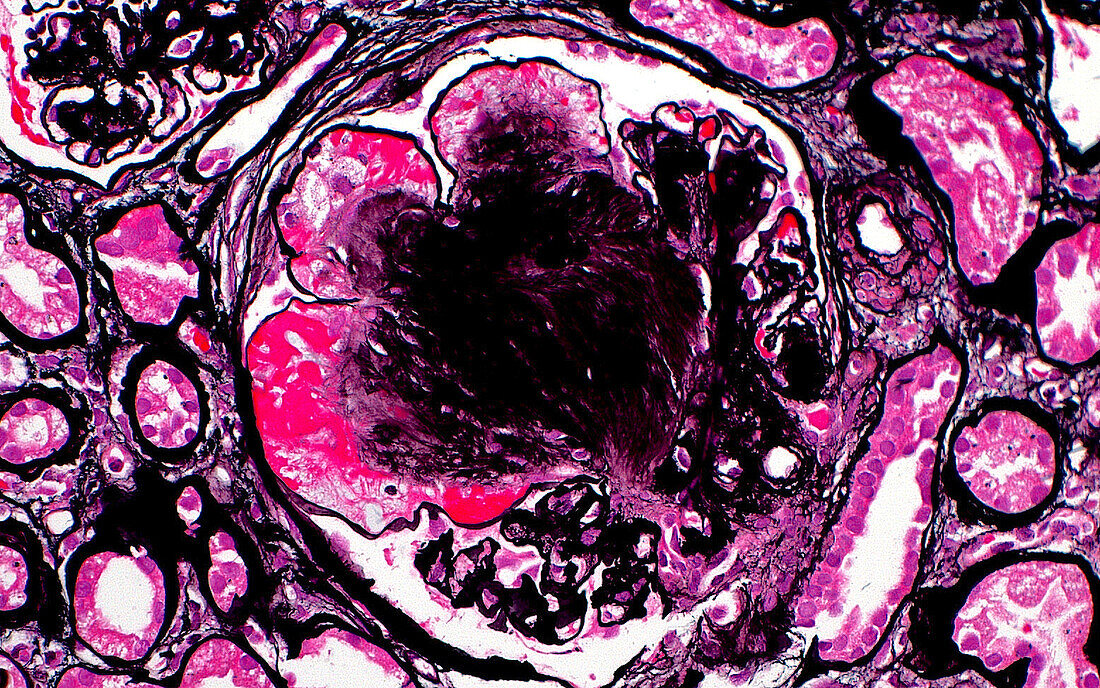 Diabetic kidney, light micrograph