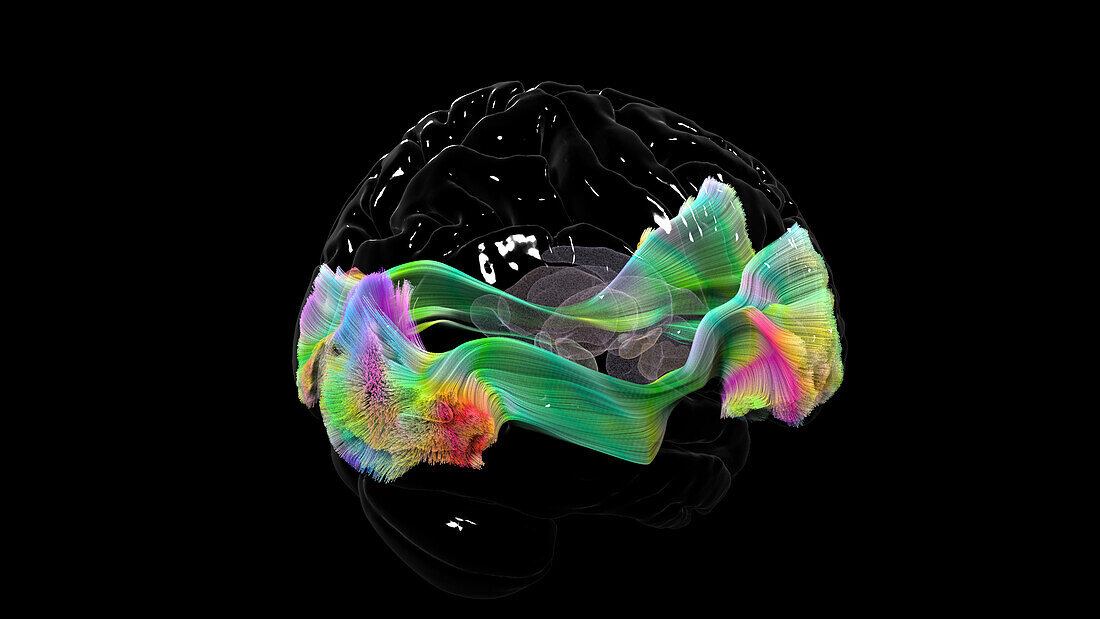 Inferior fronto-occipital fasciculus, DTI MRI scan