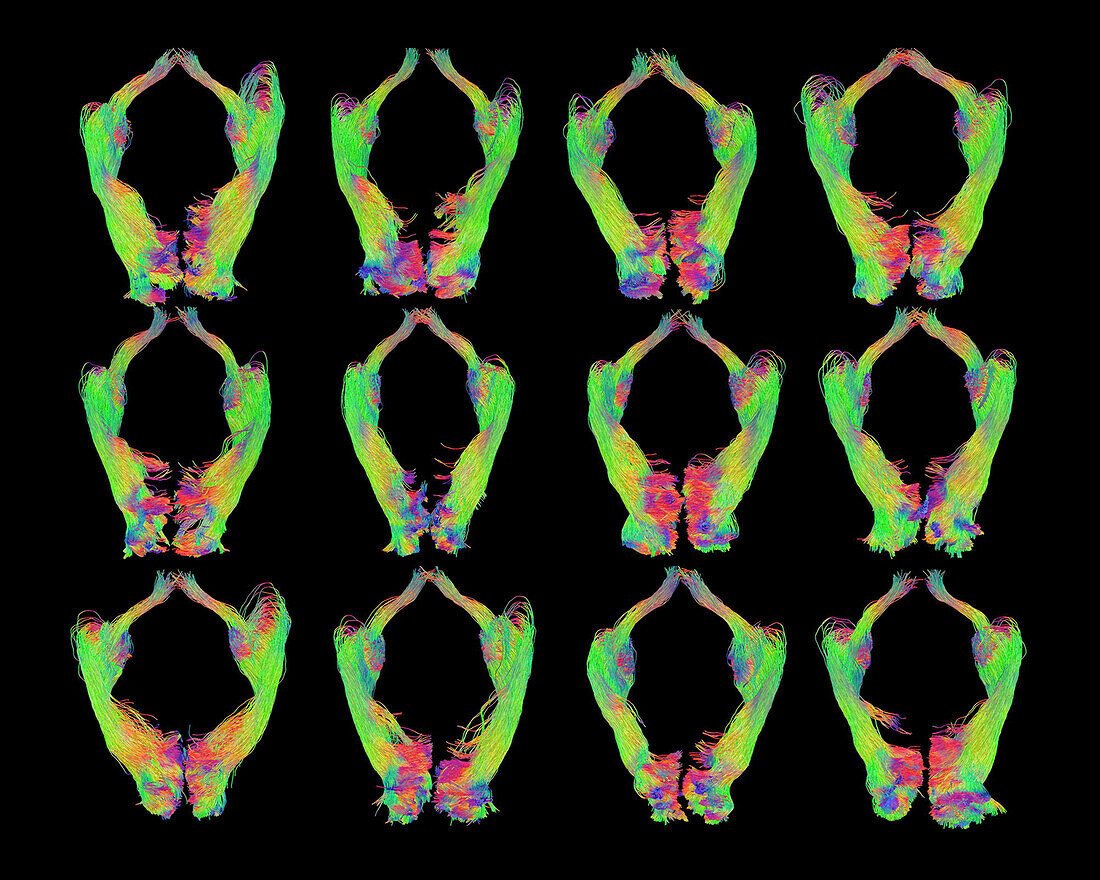 Brain's visual pathways, DTI MRI scans