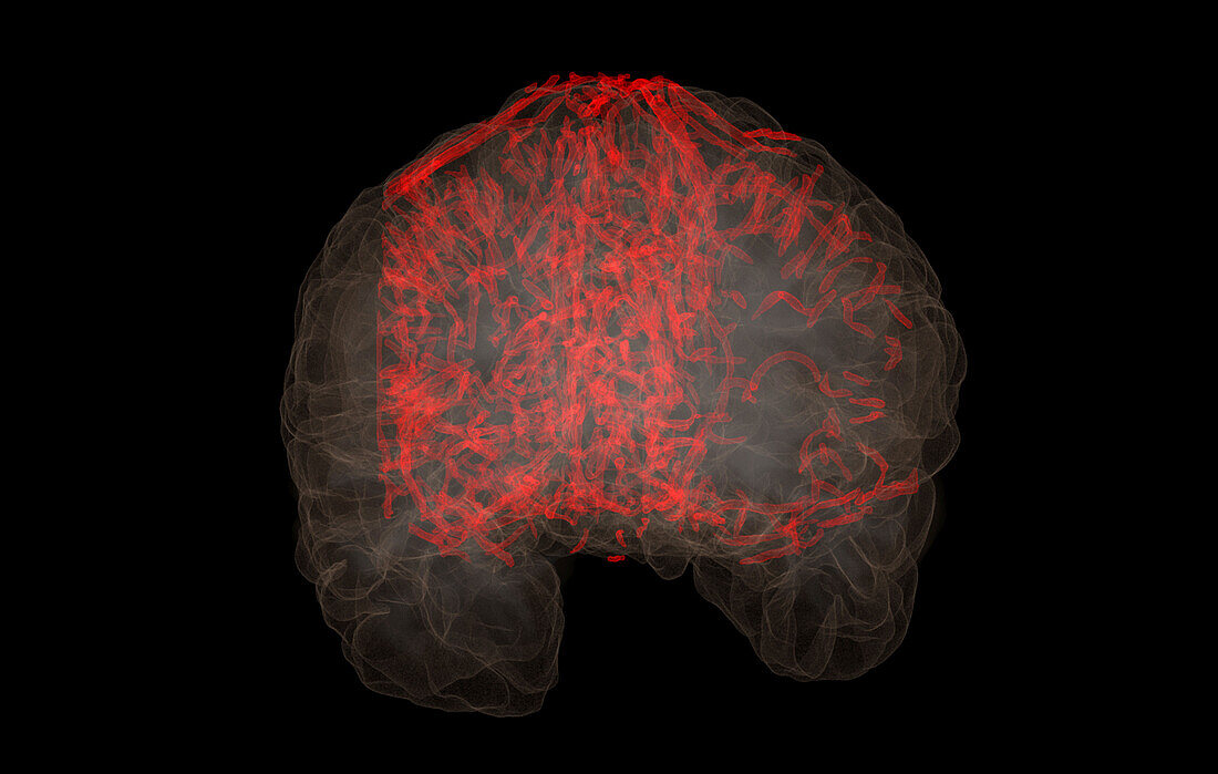 Cerebral blood vessels, MRI angiogram scan