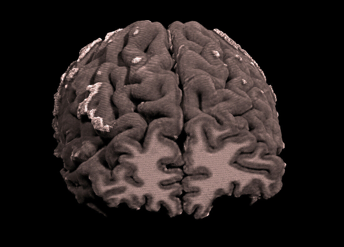 Brain, MRI scan