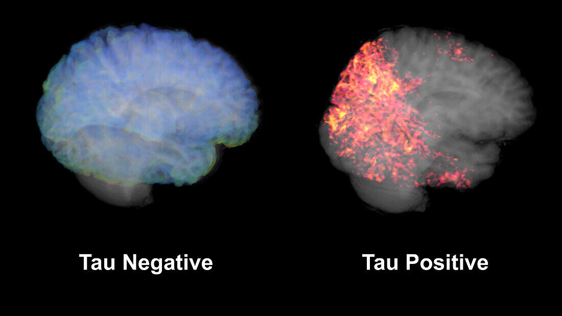 Healthy brain and brain with tau aggregations, MRI scans