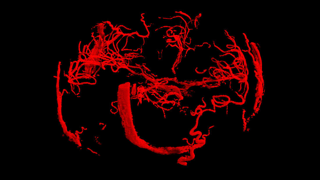 Cerebral blood vessels, MRI angiogram scan