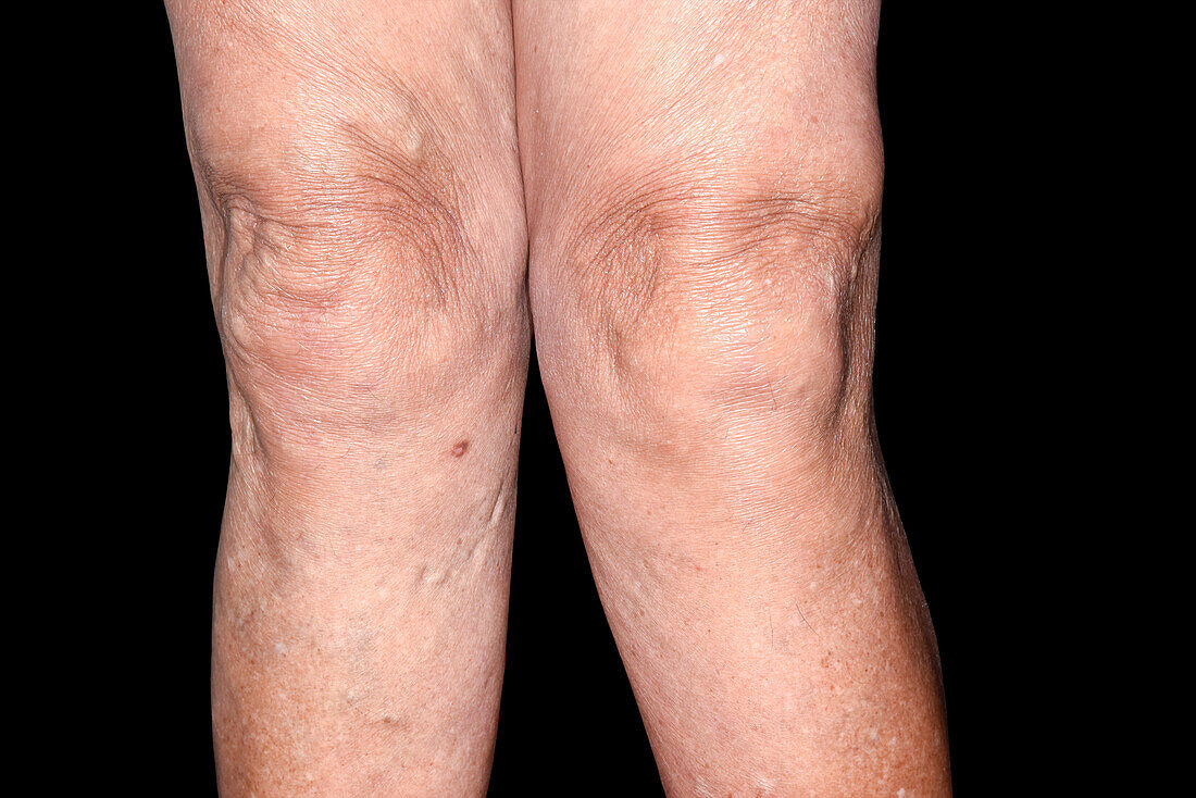 Osteoarthritis of the knees