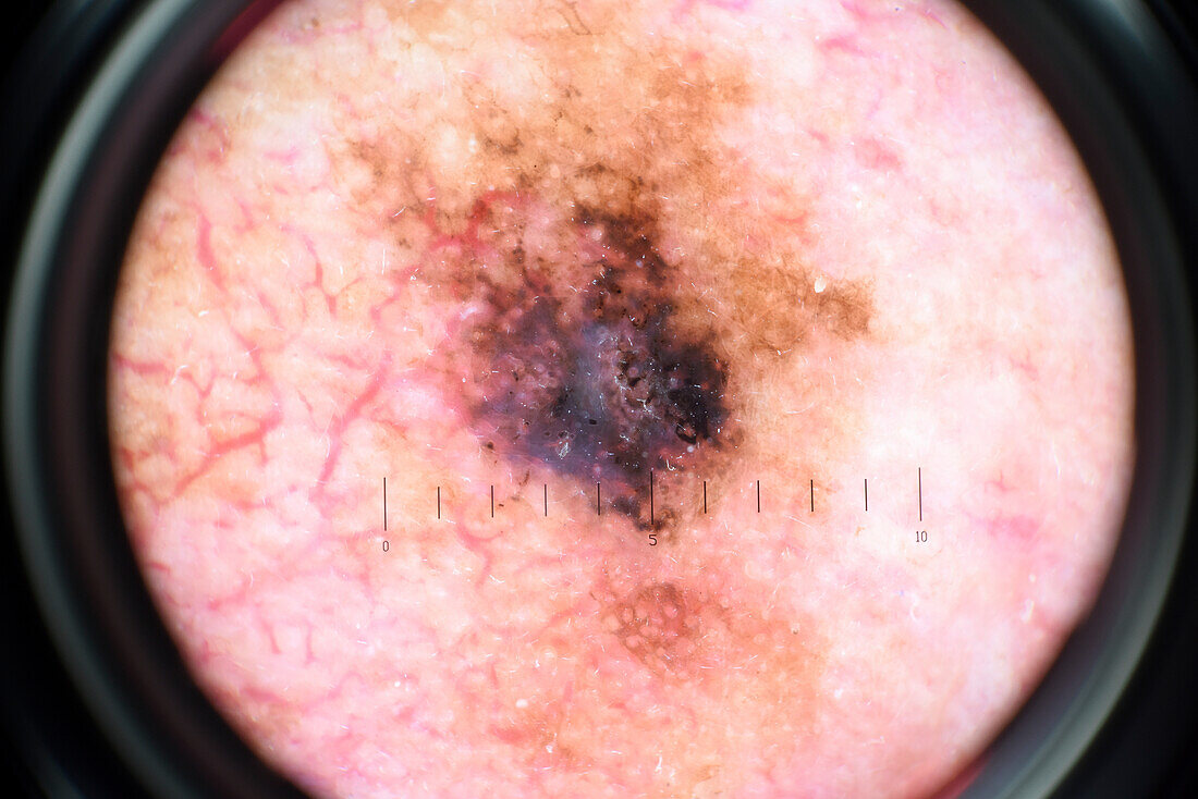 Lentigo maligna melanoma, dermoscopy