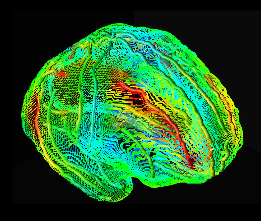 Brain in Alzheimer's disease, DTI MRI scan