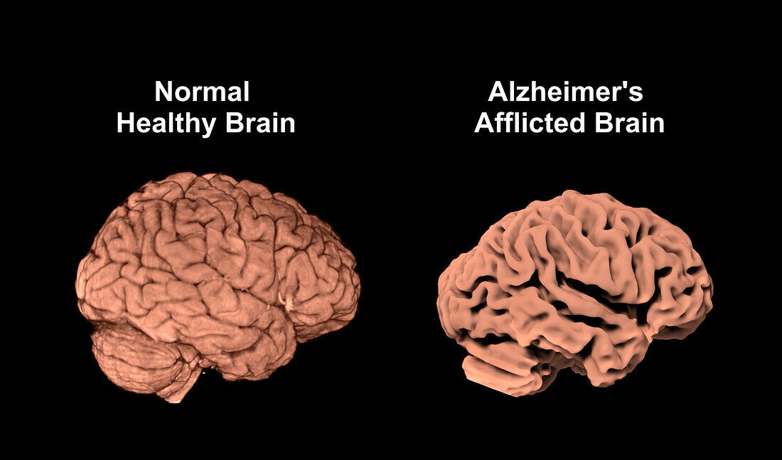 Healthy brain and Alzheimer's brain, MRI scans