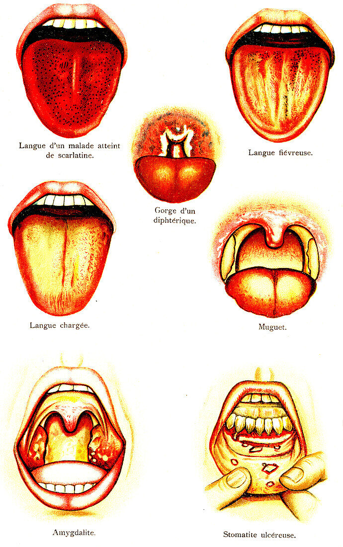 Oral diseases, illustration