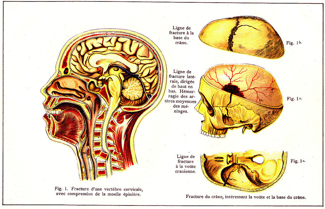 Neck and skull fractures, illustration