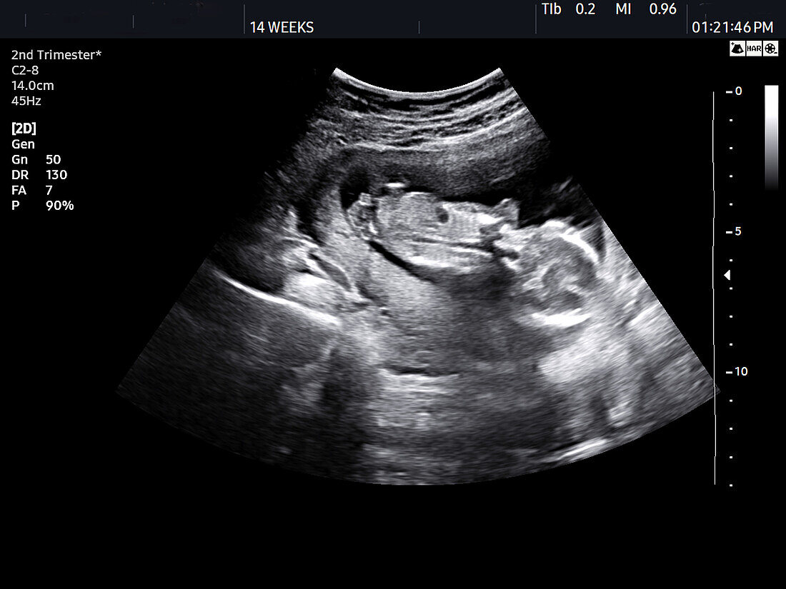 Foetus at 14 weeks, ultrasound scan