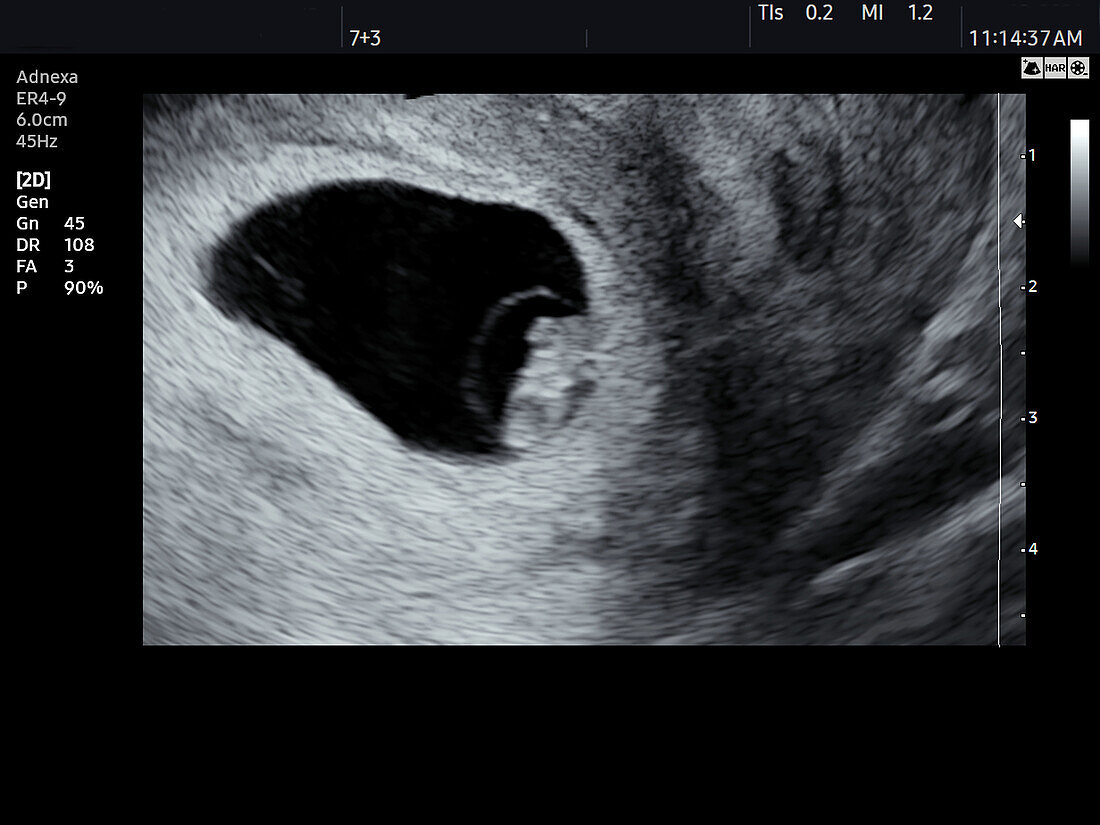 Embryo at 7 weeks, ultrasound scan