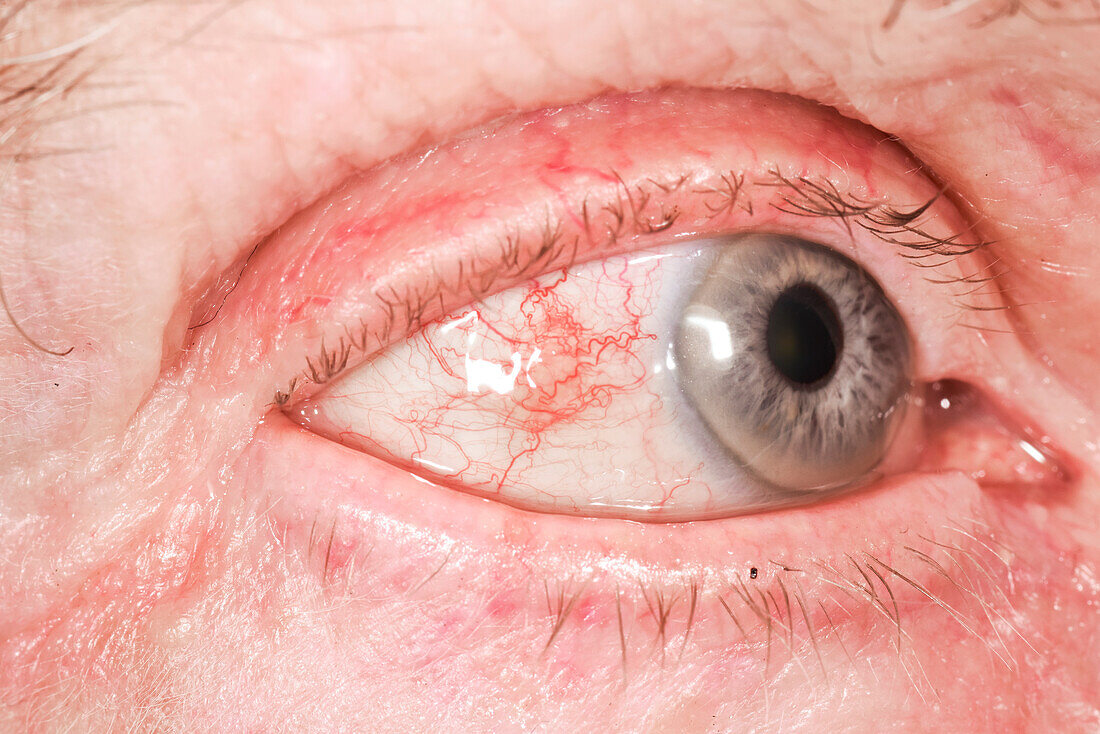 Inflamed white of the eye