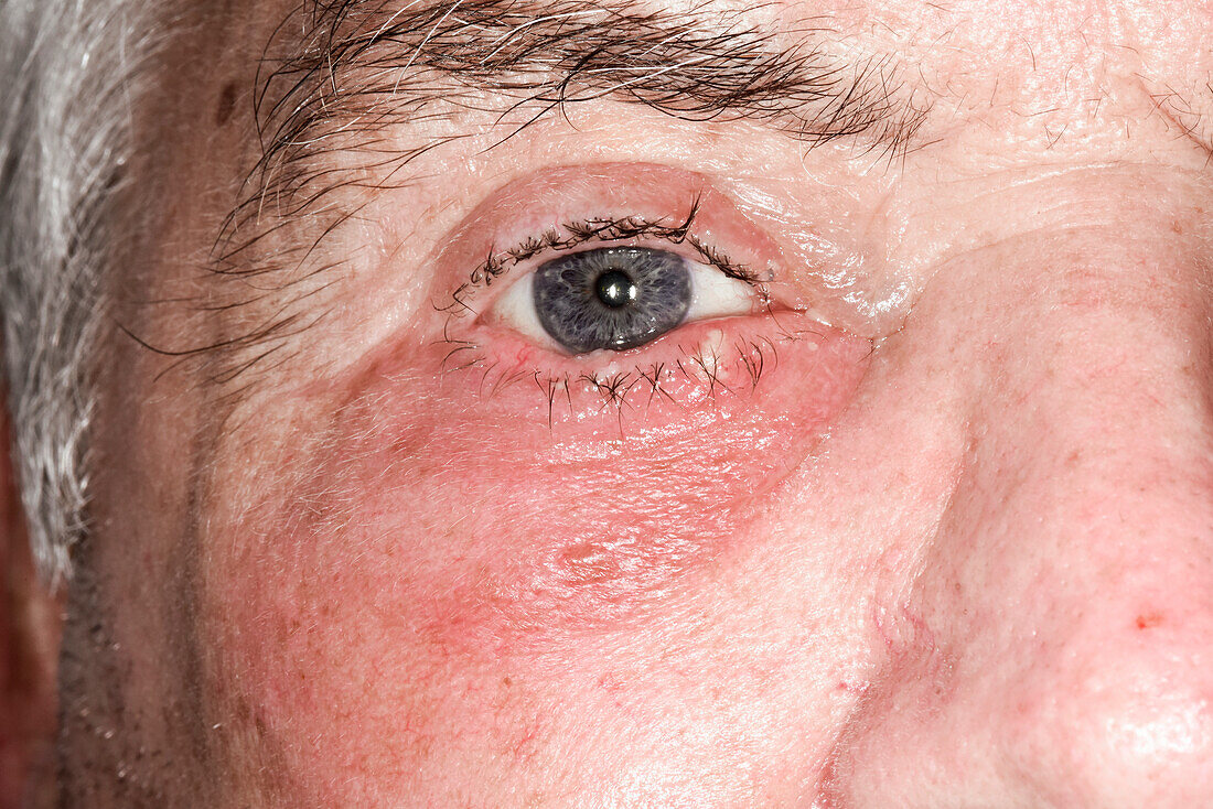 Blepharitis of the lower eyelid