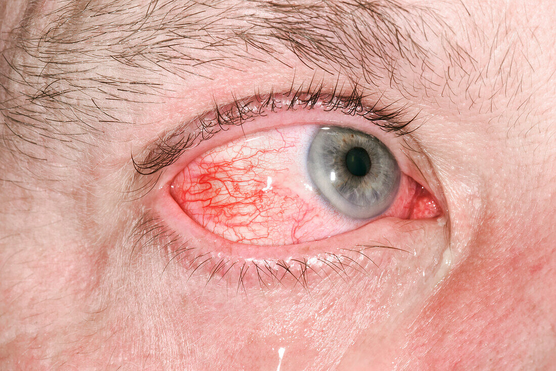 Inflamed eye