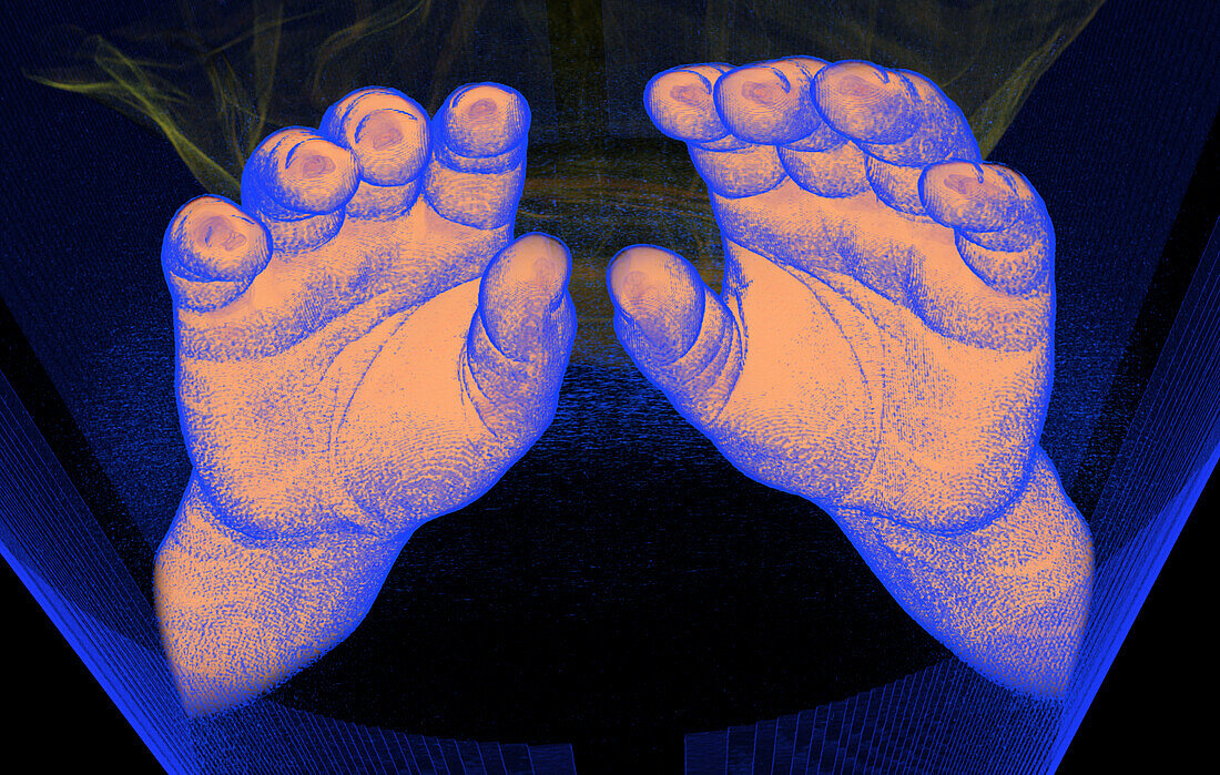 Hands and wrists, CT scan