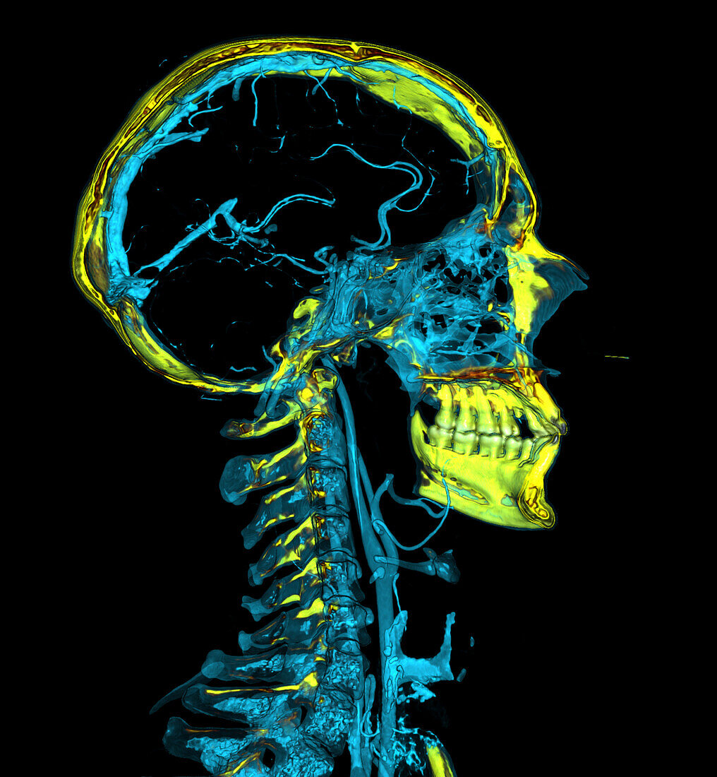 Head and neck blood vessels, CT scan