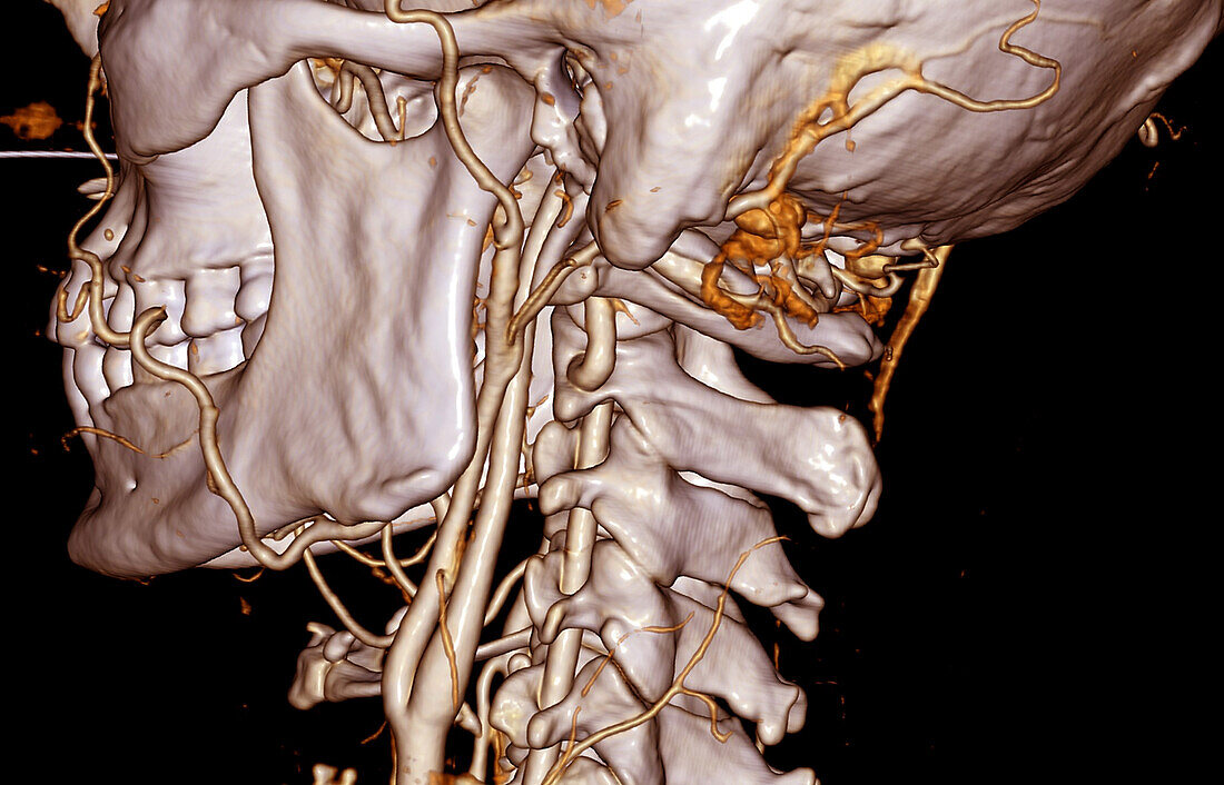Neck blood vessels, CT scan