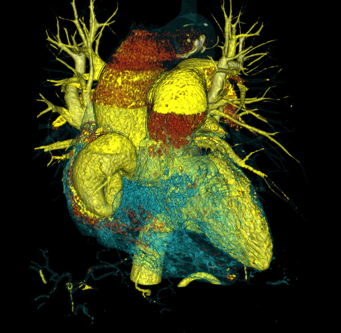Coronary artery aneurysm, CT scan