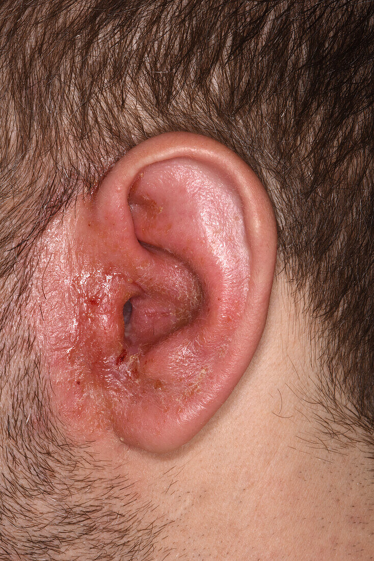 Otitis externa on a man's ear