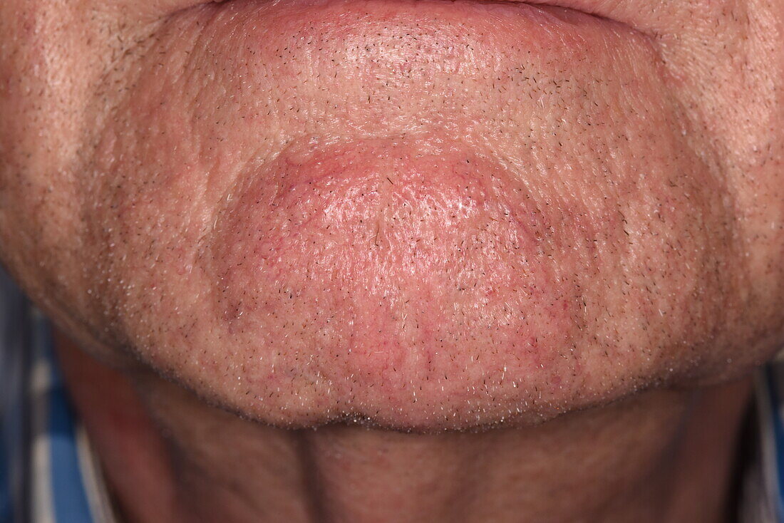 Rosacea on a man's chin