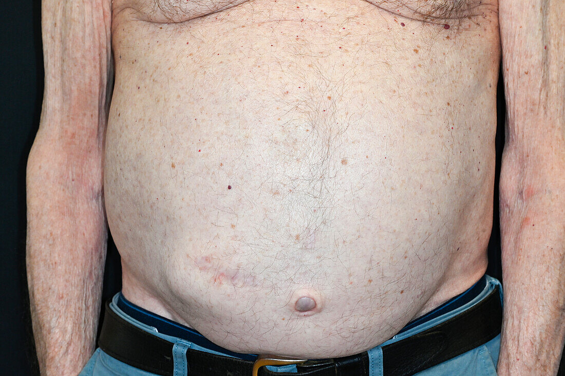Swollen abdomen due to ascites on a male patient