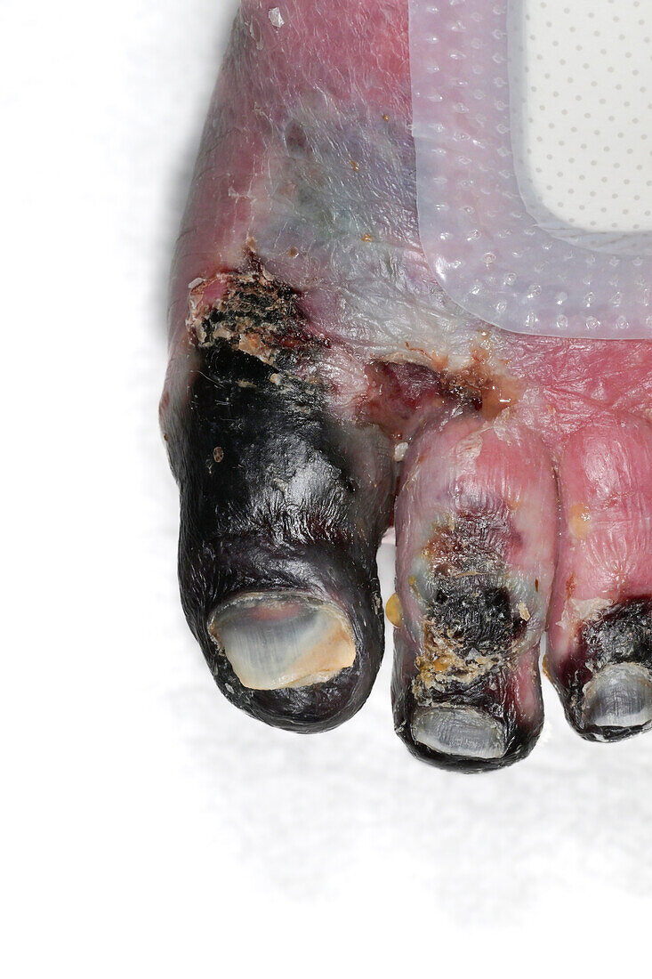 Gangrene from peripheral vascular disease on a woman's toes