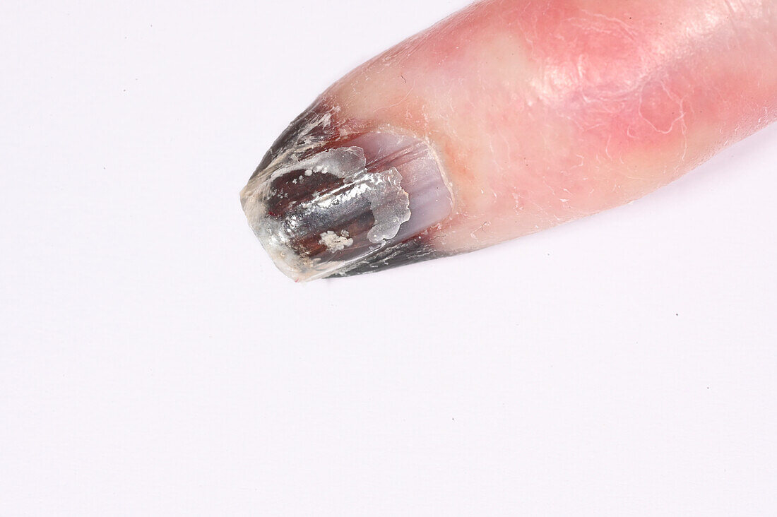 Gangrene on a woman's finger