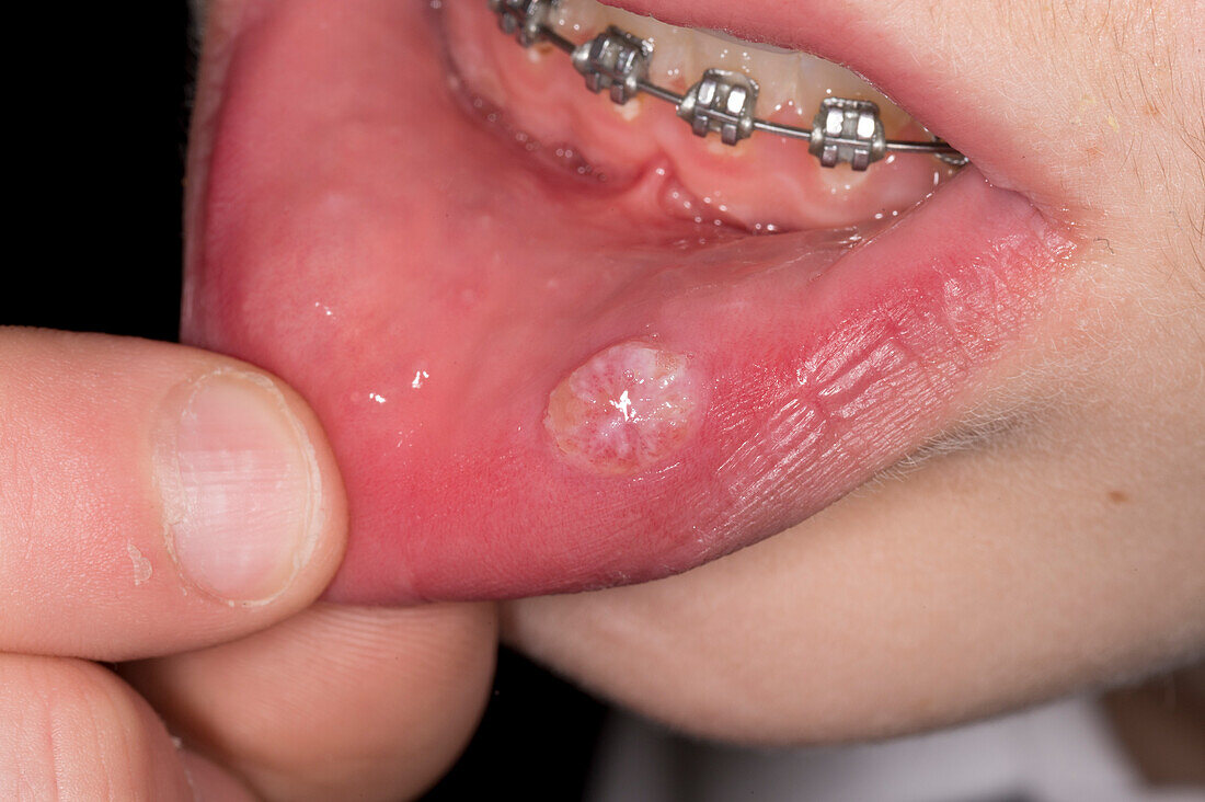 Squamous cell papilloma on a woman's lip
