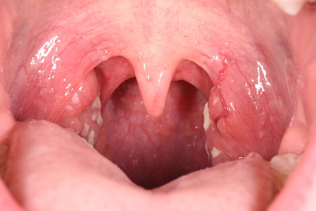 Tonsillitis in a girl's throat