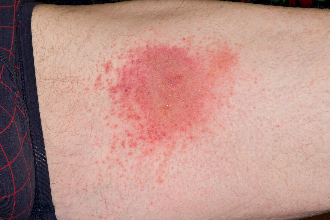 Allergic reaction to insect bite on a man's inner thigh