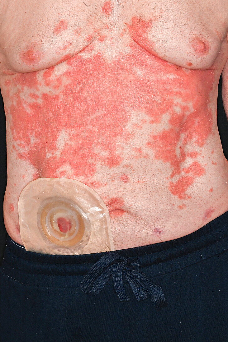 Rash from adverse cancer drug reaction on man's torso