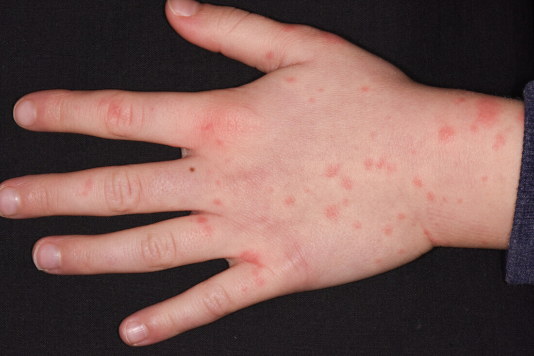 Erythema multiforme on a girl's hand
