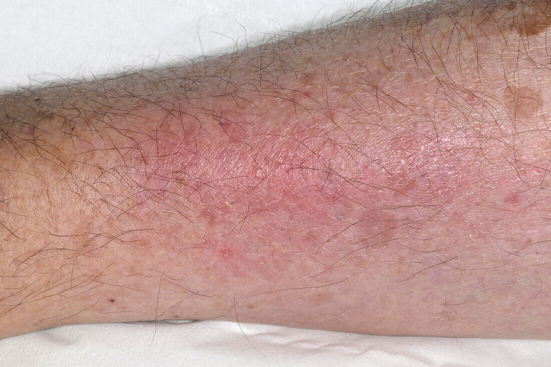 Phlebitis on a man's arm
