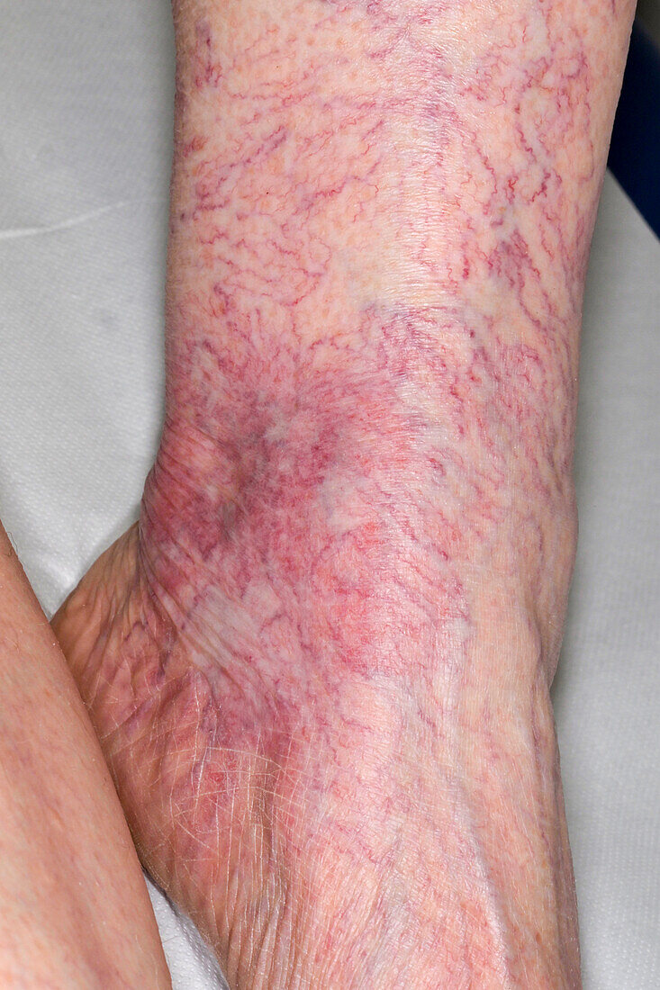Thread veins on a woman's lower leg