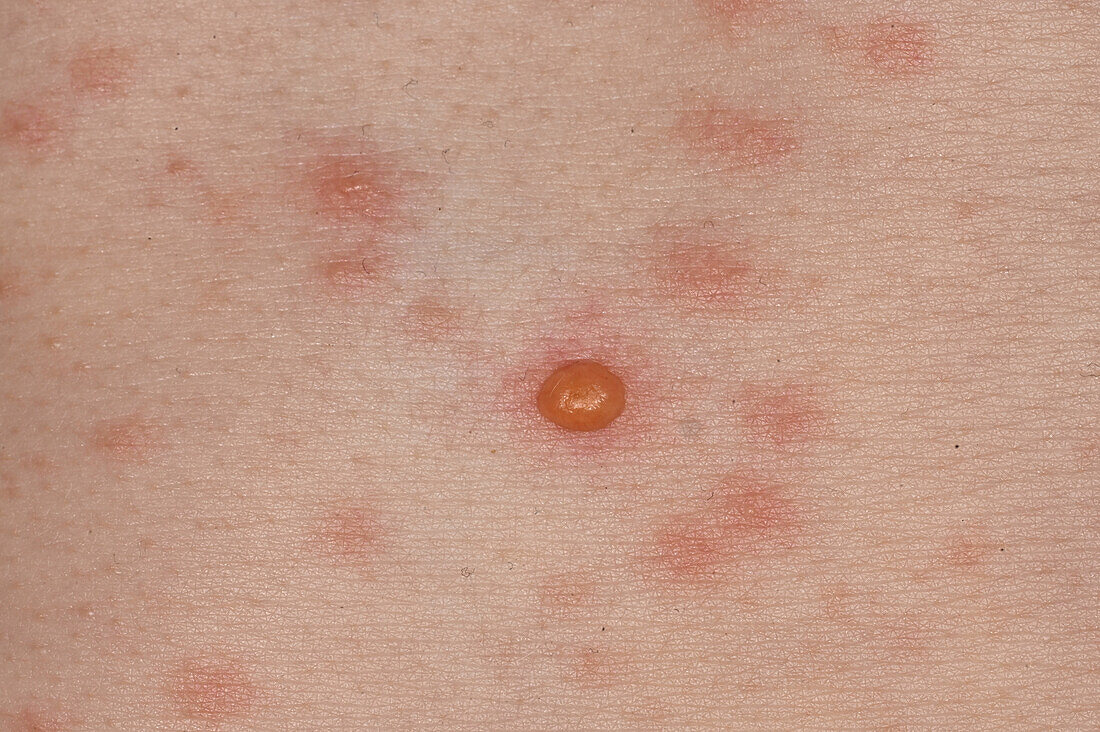 Chickenpox lesion on a girl's trunk