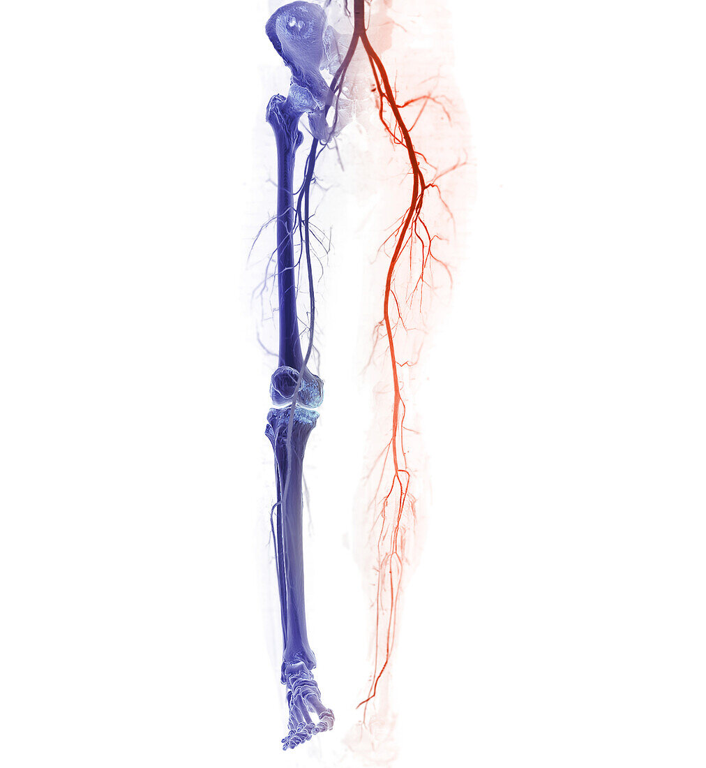 Leg arteries, CT scan