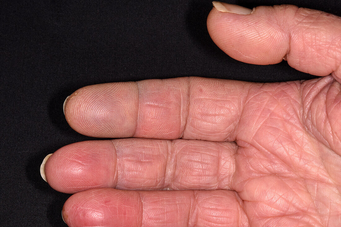 Raynaud's phenomenon in a woman's hand