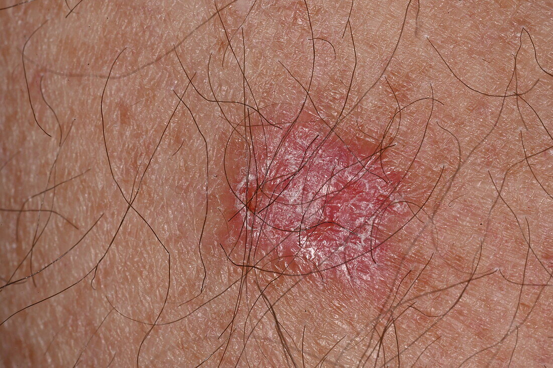 Basal cell carcinoma on a man's arm