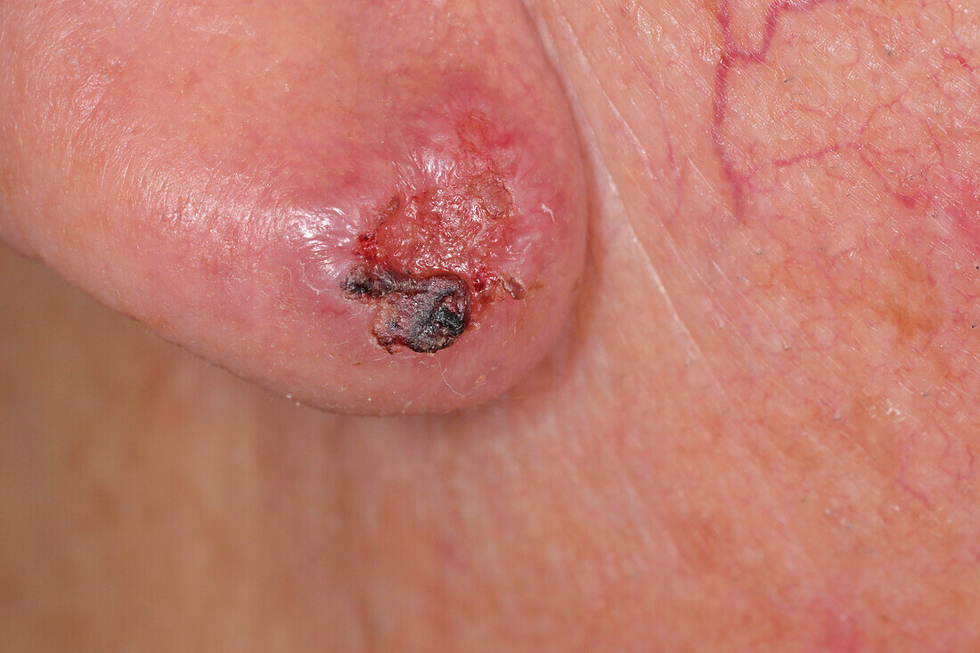 Basal cell carcinoma on a man's earlobe