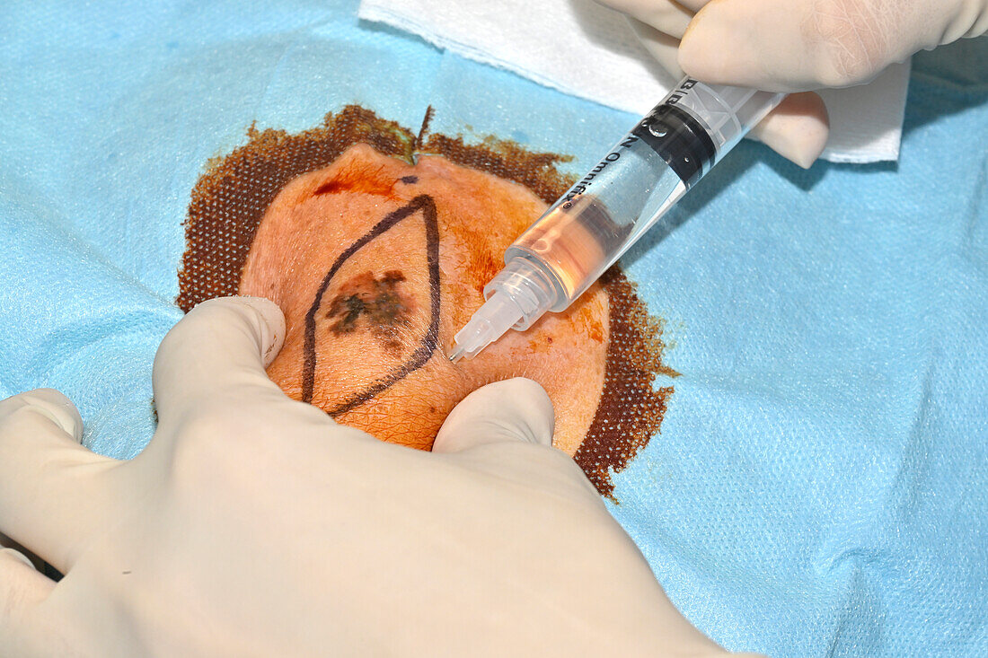 Malignant melanoma excision