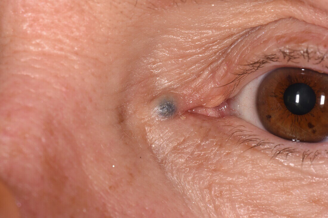Hidrocystoma on a woman's eye