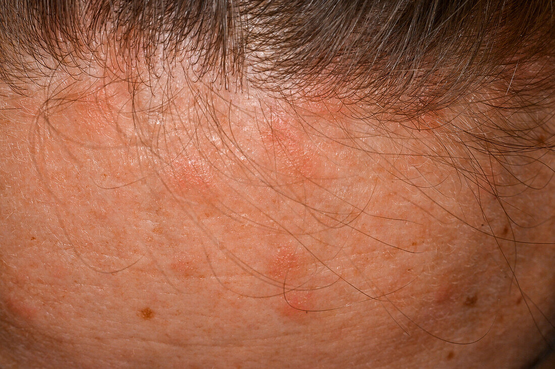 Psoriasis on a woman's forehead