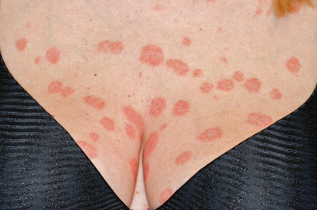 Psoriasis on a woman's chest