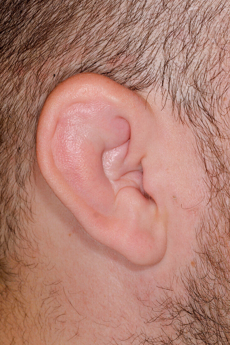 Cauliflower ear on a male patient