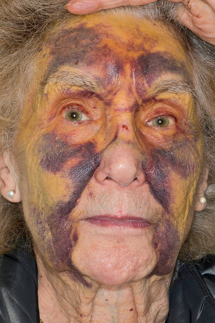 Facial bruising following fall