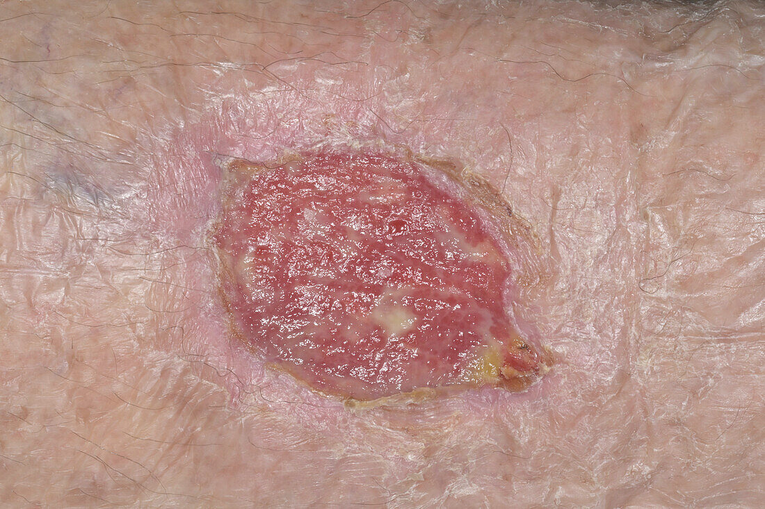 Wound after skin cancer excision on a woman's leg