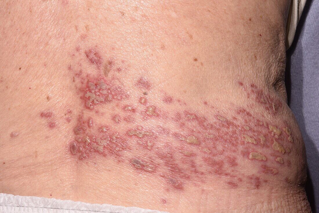 Shingles rash on a woman's trunk