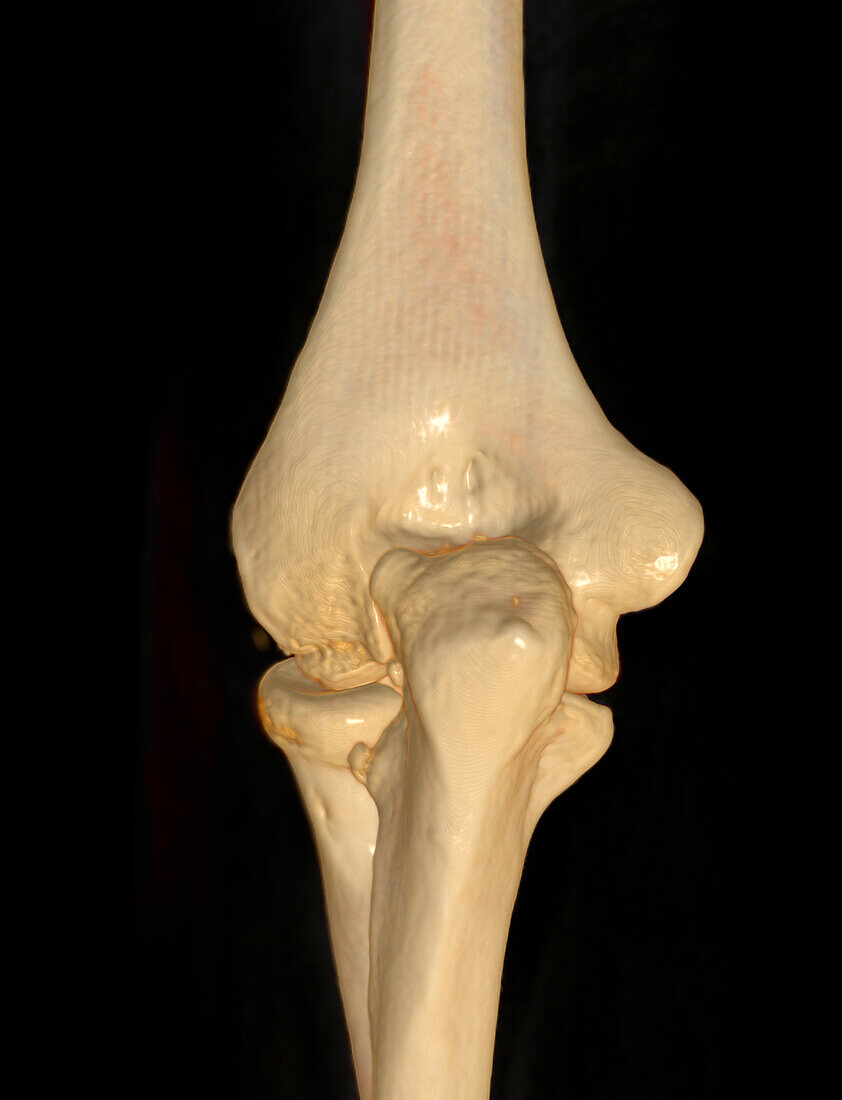 Healthy elbow joint, CT scan