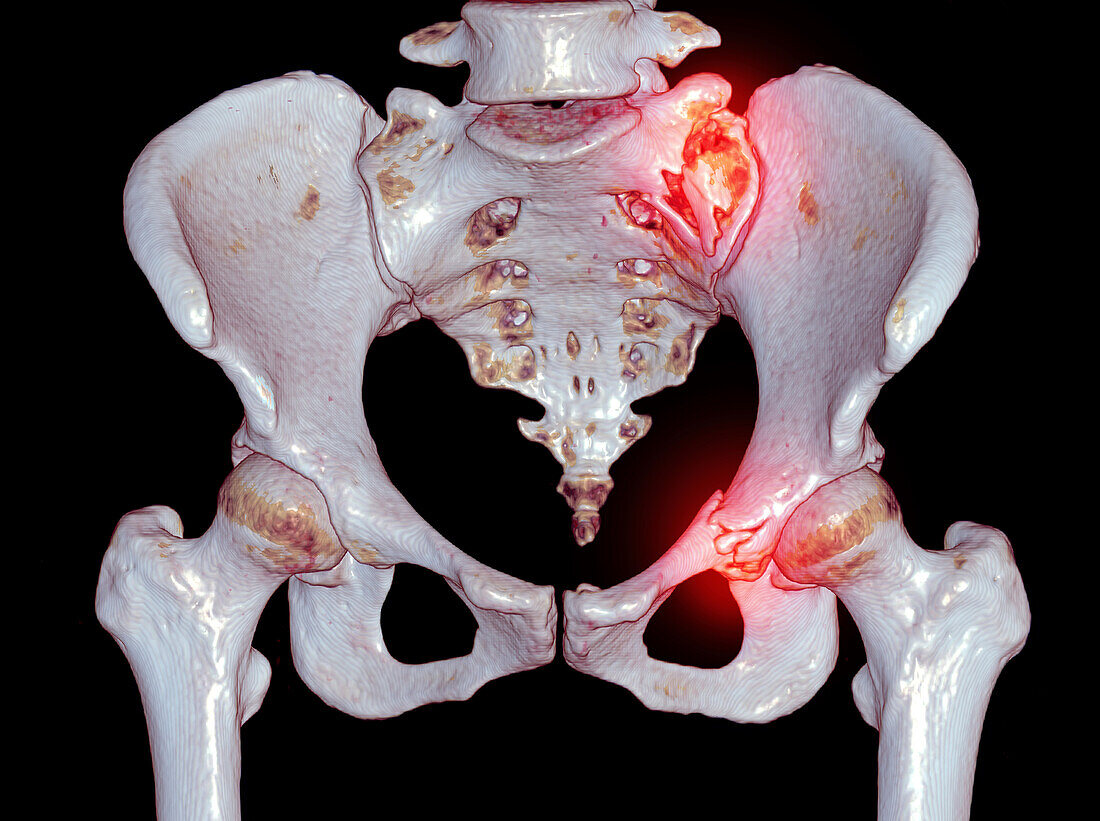 Fractured pelvis, CT scan